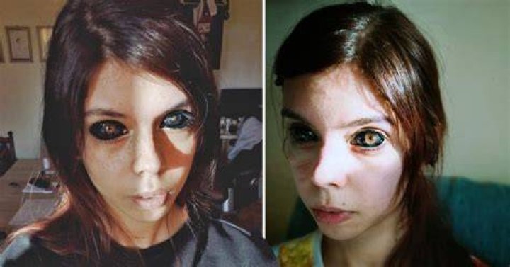 25-Yr-Old Woman Goes Completely Blind After Getting Her Eyeballs Dyed