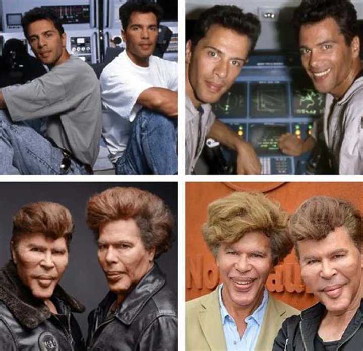 All You Need To Know About Bogdanoff twins: Life before and after surgery