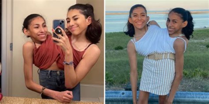 Check Out The Beautiful Twin Sisters That Were Cut Into Two Through Surgery (PHOTOS)