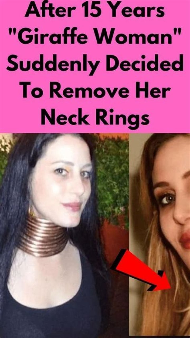 Giraffe Woman Before & After Neck Ring Removed (Photos)