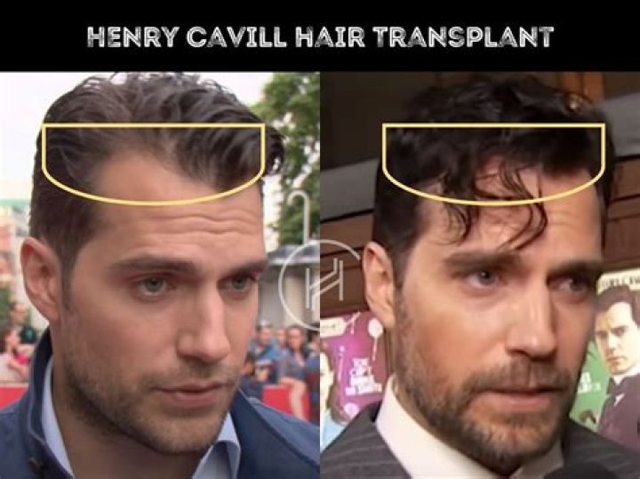 Has Henry Cavill Had Plastic Surgery? Who is Henry Cavill?