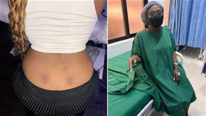 Lady Hospitalized After Getting A Back Dimple Piercing