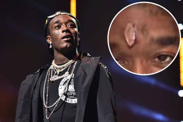 Lil Uzi Vert Removes $24 million Pink Diamond Implanted On His Forehead
