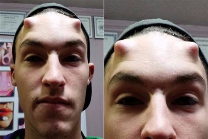Man Gets Horns Implanted In His Forehead To Look Like The Devil