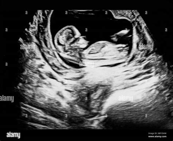 Pregnant Woman Posts Ultrasound Photo Of Her Baby Flexing His Muscles While In Her Womb