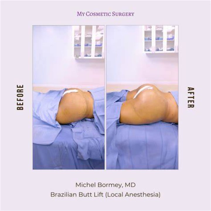 Real Reason I Did Butt Enlargement Surgery – Mercy Eke
