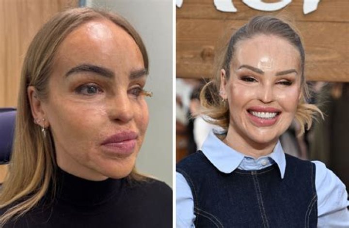 What Happened To Katie Piper Face?