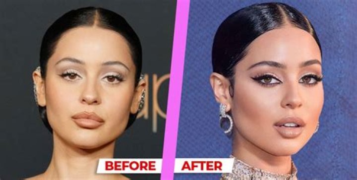 What surgery Did Alexa Demie have?