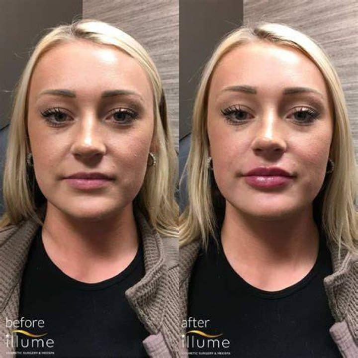 Woman’s Lips Over-Enlarges To ‘Eight Times The Normal Size’ After Injecting Lip Fillers